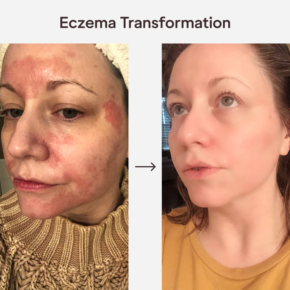 Smiles & Joys Eczema and Psoriasis Herbal Cream