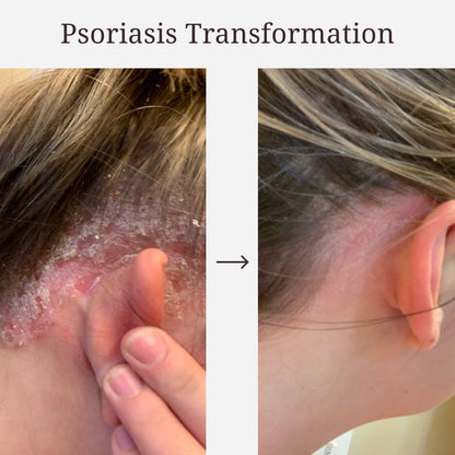 Smiles & Joys Eczema and Psoriasis Herbal Cream