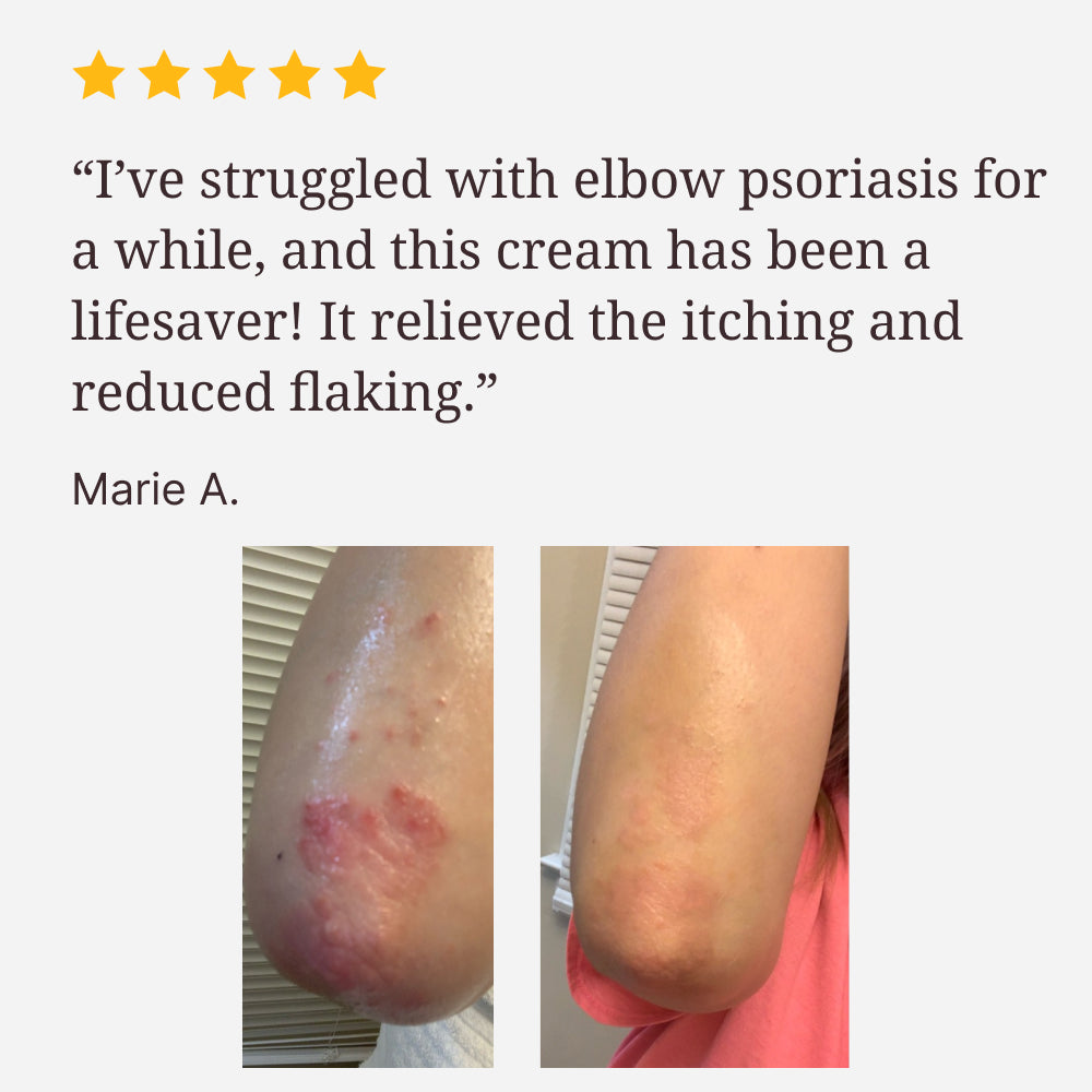Smiles & Joys Eczema and Psoriasis Herbal Cream
