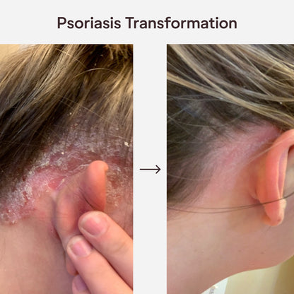 Smiles & Joys Eczema and Psoriasis Herbal Cream